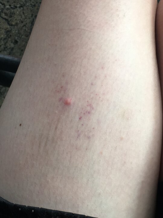 Bug Bite With Purple Dots Around It The Purple Dots Have Just Started bug-bite-thing-suction-tool-b01earo9be-encarguelo